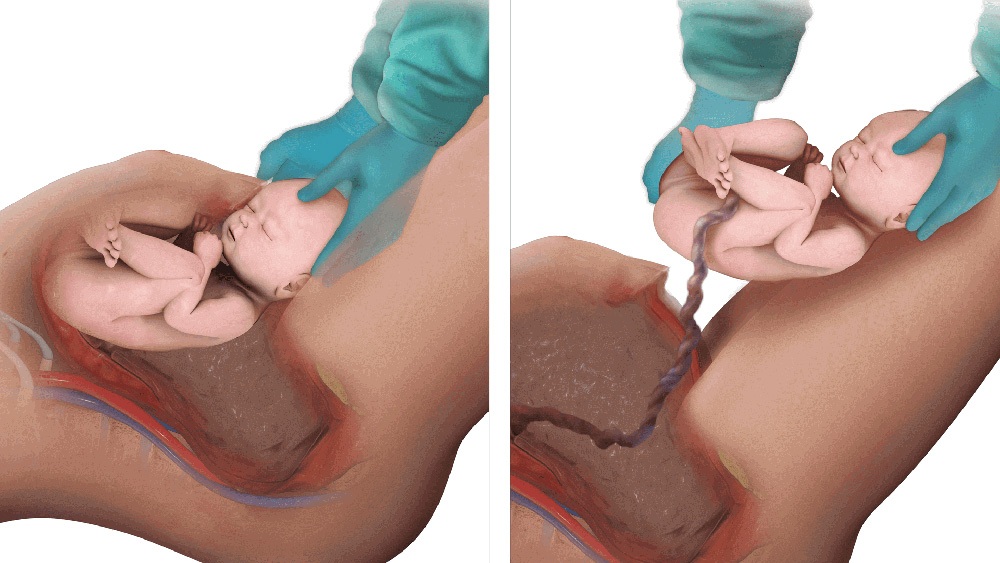 Medical illustration showing c-section