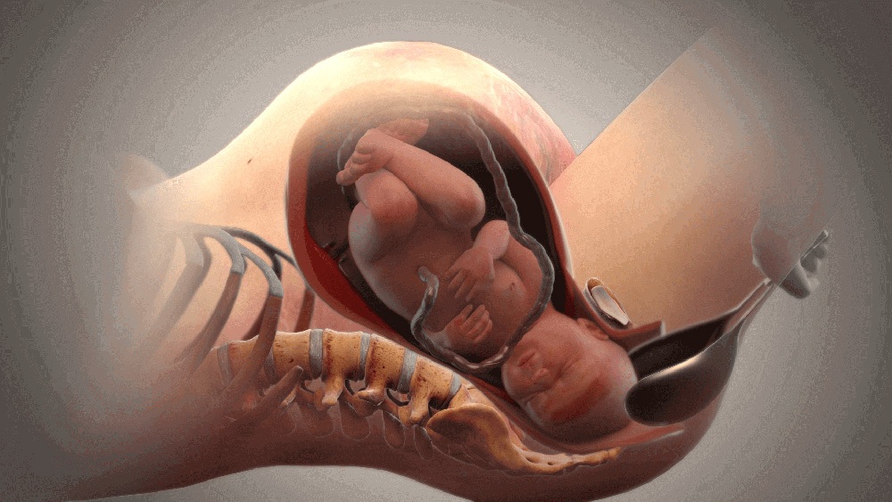 Medical animation still showing forceps delivery