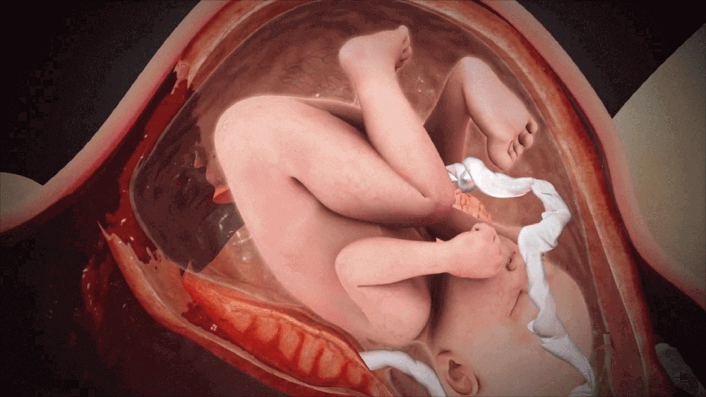 Medical animation still showing placental abruption