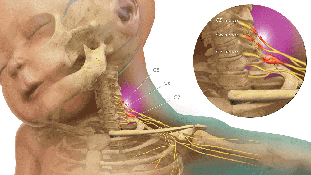 Medical illustration showing shoulder dystocia
