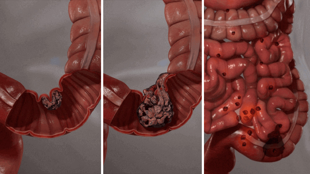 Medical illustration showing progression of colon cancer